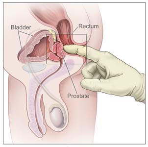 digital rectum exam