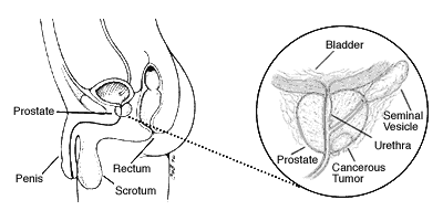 what is prostate cancer